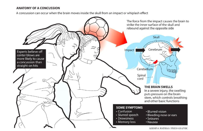 Anatomie d'une commotion cérébrale